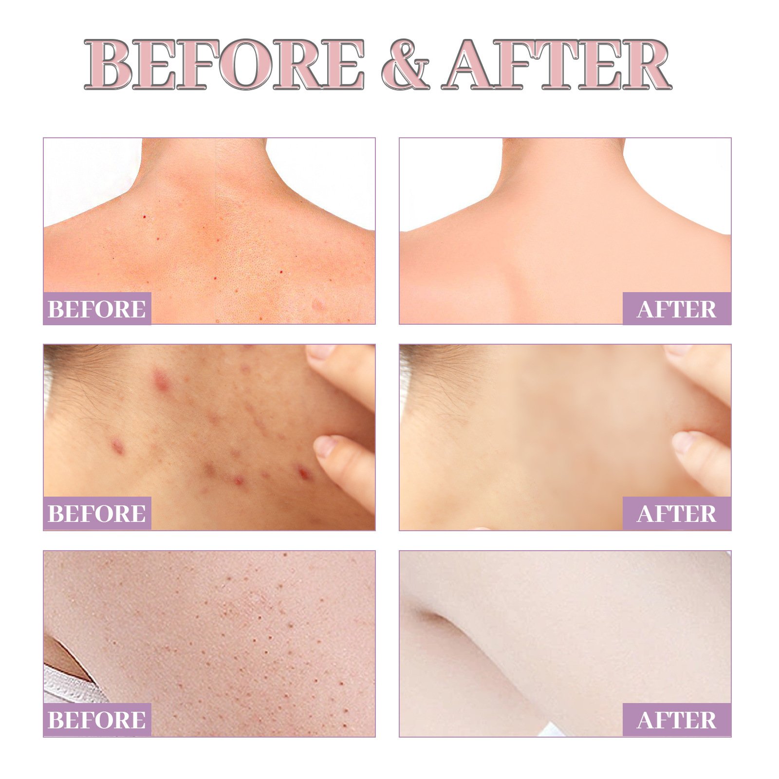 Chest Back Cleansing Fade Acne Print Skin Care Ball - Image 4