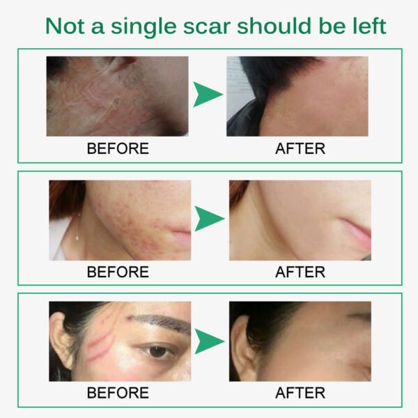 Skin Rebound Scarless Cream Scar Removal Cream Face Cream For Face Acne Scar Stretch Marks Skin Repair Face Cream - Image 8