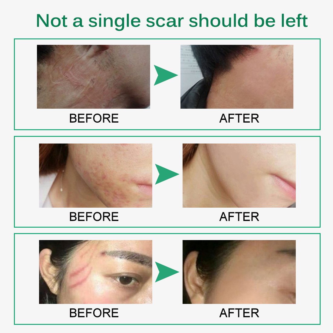 Skin Rebound Scarless Cream Scar Removal Cream Face Cream For Face Acne Scar Stretch Marks Skin Repair Face Cream - Image 8